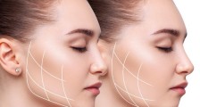 Oval Lining İle Ameliyatsız Dolgunluk